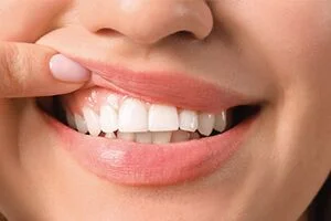 Gum depigmentation and Gum Contouring