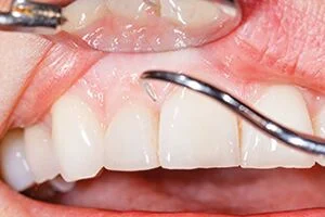Gum disease Treatment